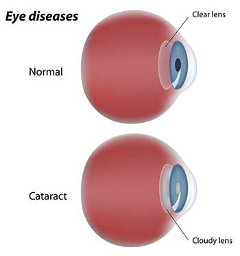 Cataracts in Bay Shore