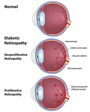 Diabetic Eye Care in Bay Shore