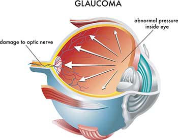 Glaucoma Treatment in Bay Shore