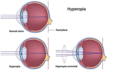 Farsightedness in Bay Shore