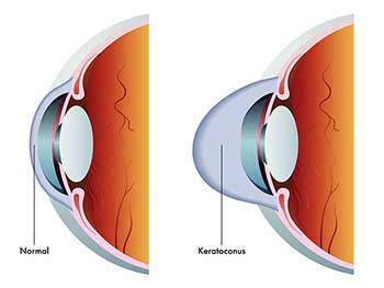 Keratoconus in Bay Shore