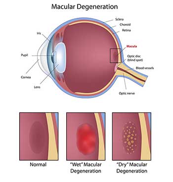 Macular Degeneration in Bay Shore