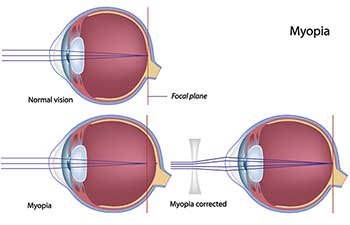 Nearsightedness in Bay Shore